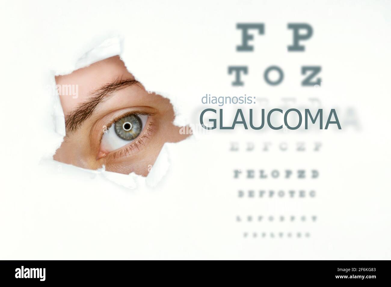 Woman`s eye looking trough teared hole in paper, eye test and word Glaucoma on right. Eye disease concept template. Isolated white background. Stock Photo